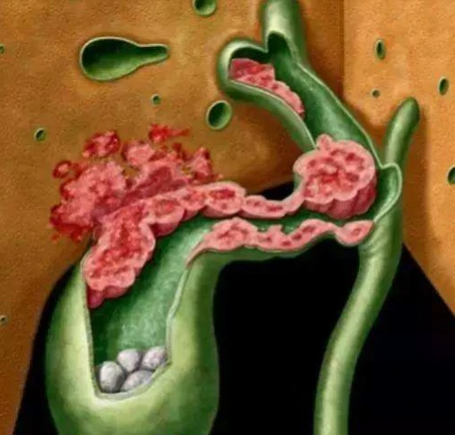 出現膽囊癌身體會有6個症狀 別忽視了 3個方法治療膽囊癌
