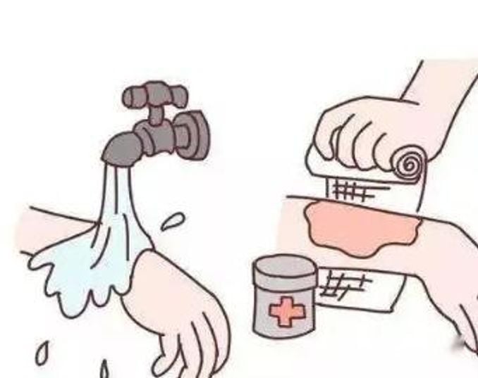 燒傷1度2度3度的區別 - 女人 - iNewsDB 日日新聞．掌握每日新鮮事